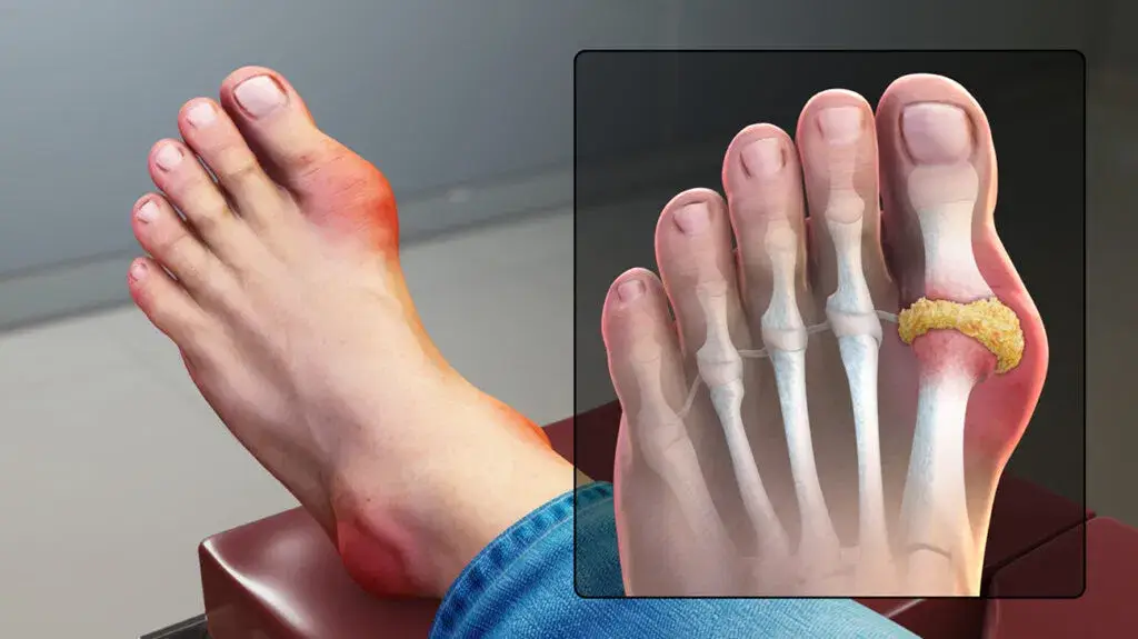 Why Gout Cases Still ‘ Flare ‘ Across America