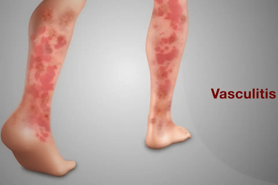 Vasculitis: Treatment, symptoms, causes, and types.